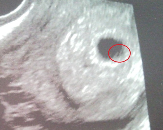 Забеременела без труб естественным путем. Желточный мешок на 5 неделе беременности на УЗИ. Плодное яйцо 16мм,эмбрион 6мм. УЗИ 6 недель беременности желточный мешок.
