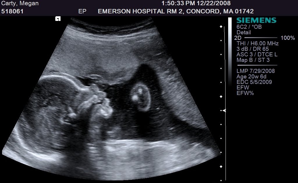 Малыш на 21 неделе беременности. Гипертонус матки на УЗИ при беременности. Гипертонус матки при беременности 2 триместр УЗИ. УЗИ на 20 недели с тонусом матки.