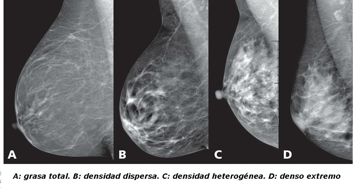 Фиброаденоматоз bi rads 2. Фиброзно кистозная мастопатия молочной железы bi-rads-4a. Фиброзно-кистозная ткань молочной железы. Плотность молочной железы на маммографии. Фиброзно-кистозная мастопатия молочных желез на маммографии.