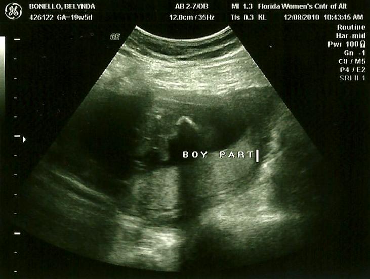 18 недель мальчик. УЗИ 18 недель беременности мальчик. УЗИ на 19 неделе беременности пол. УЗИ 17-18 недель беременности мальчик. УЗИ 19 недель беременности девочка.