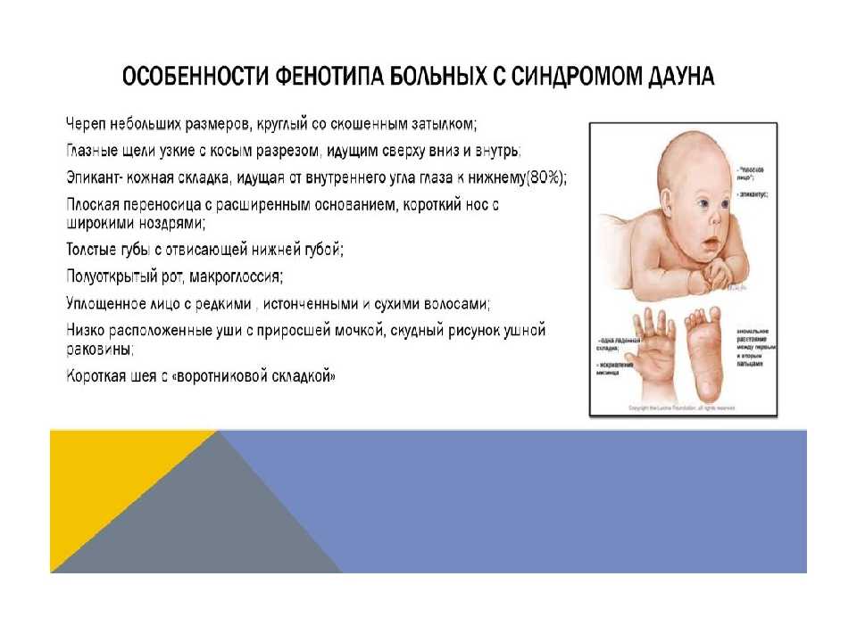Фенотип ребенка с синдромом дауна