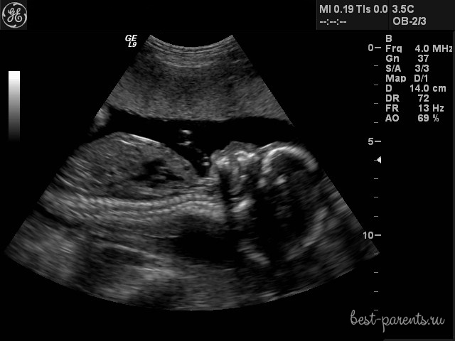 37 недель мальчик. УЗИ 37 недель беременности. УЗИ 37-38 недель беременности. УЗИ ребенка на 37 неделе беременности. Фото УЗИ 37 недель беременности.