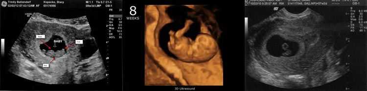 Фото на узи на 8 неделе беременности фото узи