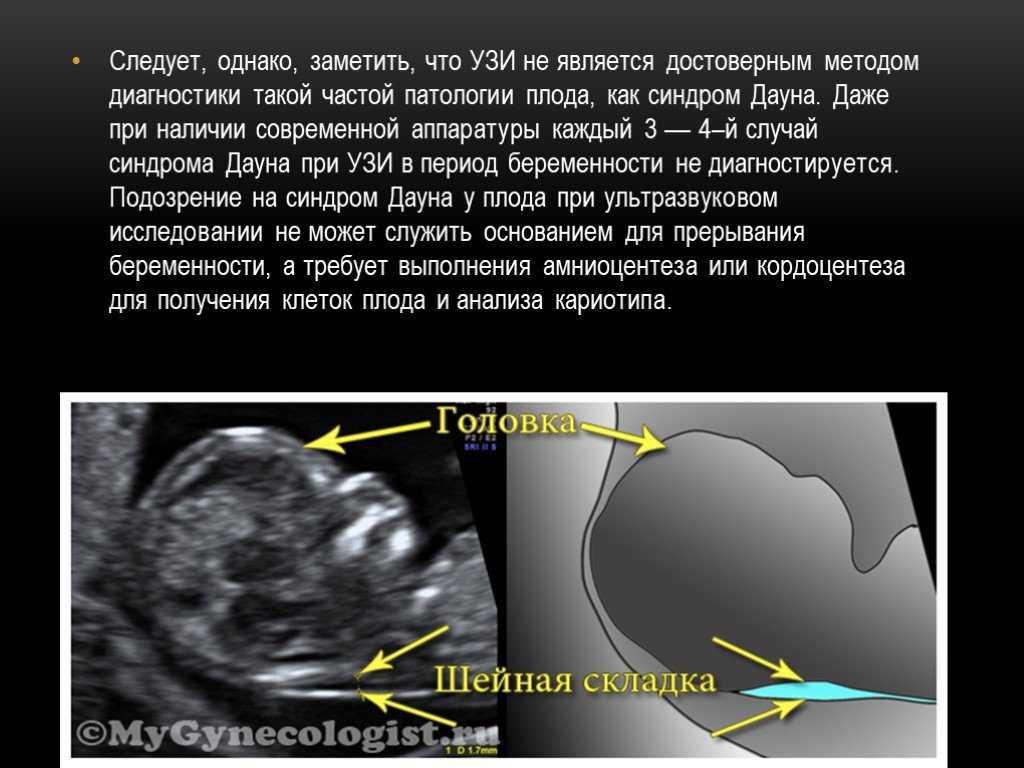 Узи определение. Скрининг УЗИ синдром Дауна. УЗИ 1 триместр беременности синдром Дауна. УЗИ плода с синдромом Дауна в 3 триместре. Синдром Дауна на УЗИ 12 недель.