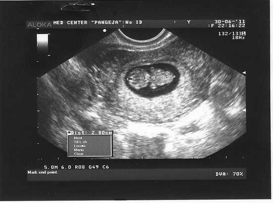 Симптомы 10 недели. УЗИ на 10 акушерской неделе беременности. 10 Недель беременности фото плода на УЗИ. Фото УЗИ на 9 неделе беременности акушерской. УЗИ 9.5 недель беременности.