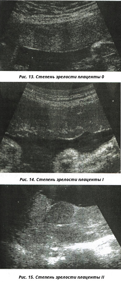 Степень зрелости плаценты