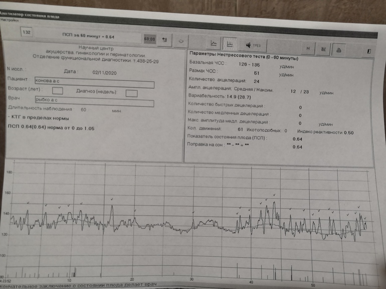Ктг при беременности что это. Результаты КТГ. КТГ фото результатов. КТГ заключение. Как понять что КТГ хорошее.