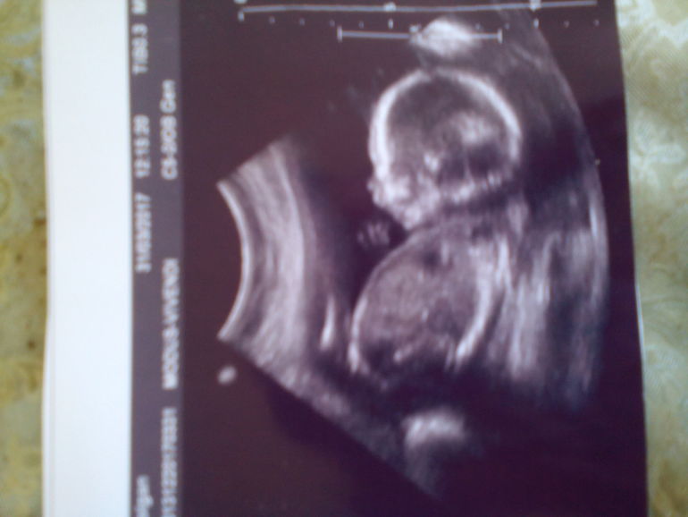 18 недель мальчик. УЗИ 18 недель беременности мальчик. УЗИ 18 недель беременности девочка. УЗИ 19 недель беременности.
