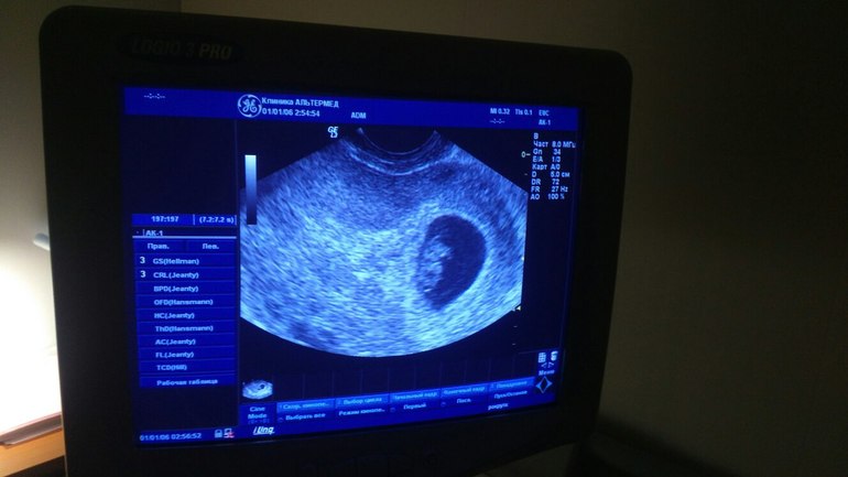 Узи 6 месяцев. УЗИ на 8ой неделе беременности. Снимок УЗИ 3 месяца беременности на мониторе. УЗИ беременности с монитора. УЗИ 4 недели беременности на мониторе.