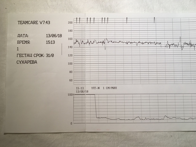 Ктг форум. Хорошее КТГ. Первое КТГ. Пульс на КТГ. Плохое сердцебиение на КТГ.