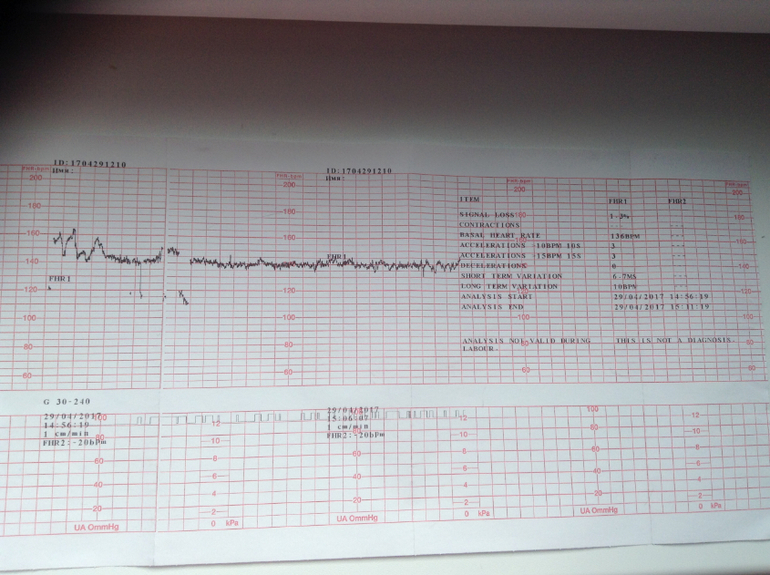 Ктг ребенка