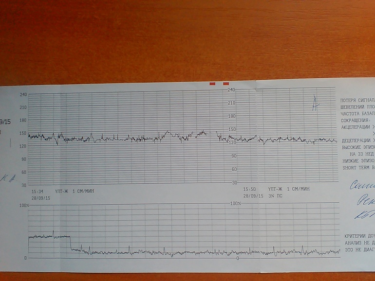 Шевеления плода на 39 неделе беременности. Шевеление плода на КТГ как выглядят. Нормальный пульс на КТГ У ребенка. КТГ плода аппарат без кнопки. Шевеления плода на КТГ при схватках.