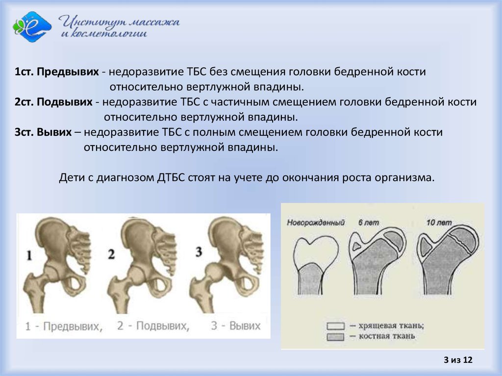 Схема врожденного вывиха бедра