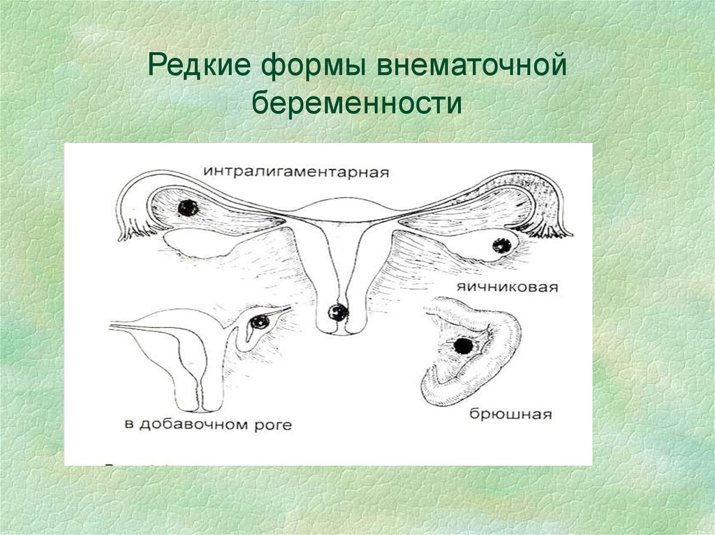 Эктопическая беременность. Эктопическая Трубная беременность. Редкие формы внематочной беременности. Формы трубной беременности. Истмическая внематочная беременность это.