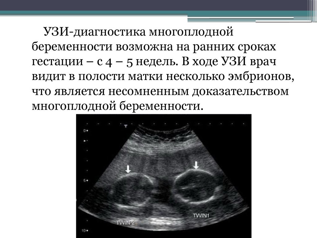 Когда срок на узи видно. Многоплодная беременность УЗИ. УЗИ критерии многоплодной беременности. УЗИ беременности на ранних. УЗИ беременности на ранних сроках.