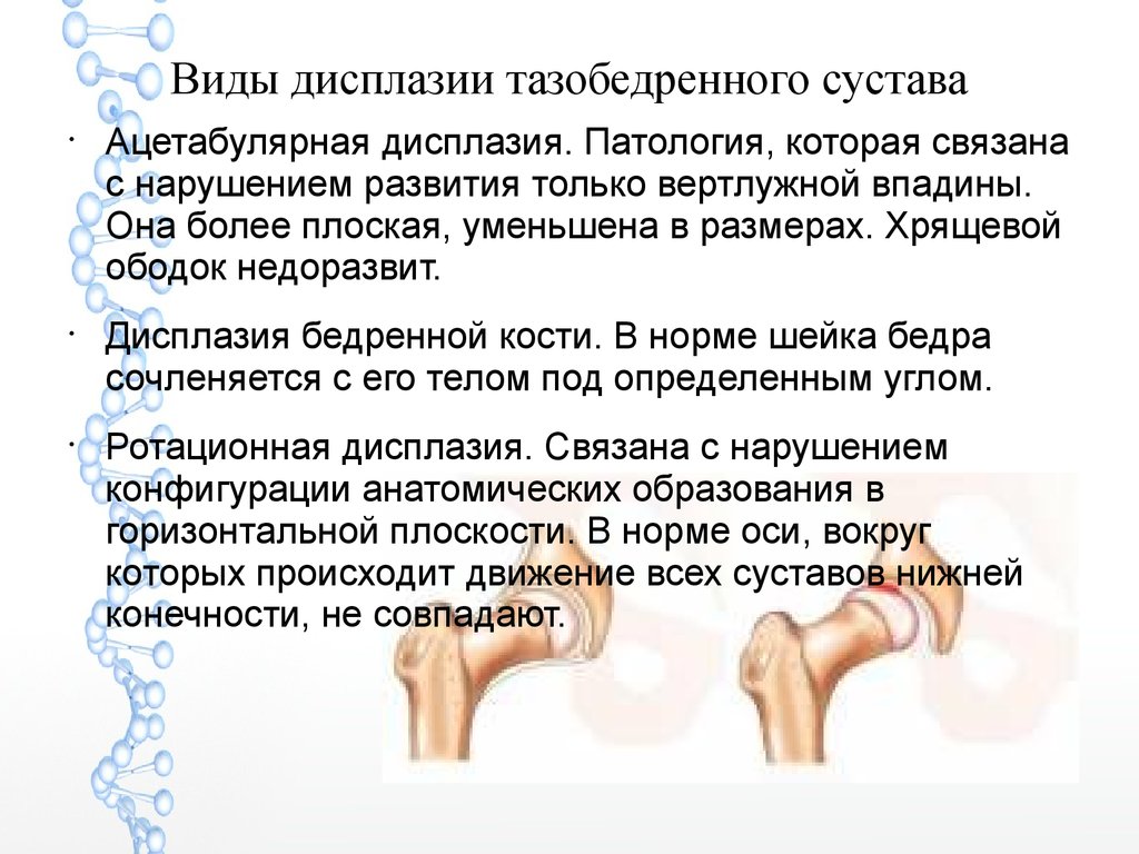 Признаки дисплазии. Классификация дисплазии вертлужной впадины. Дисплазия головки бедренной кости у детей. Дисплазия тазобедренных суставов стадии. Ацетабулярная дисплазия тазобедренных суставов стадии.