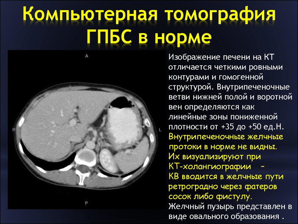 Плотность печени hu. Плотность печени на кт норма. Плотность паренхимы печени норма.