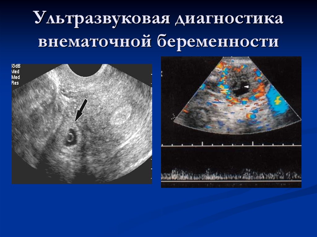 Матка увеличена до 6 недель. Внематочная Трубная беременность УЗИ. УЗИ признаки трубной беременности. Внематочнаябкременность УЗИ. Внематочная беременность на УЗИ.