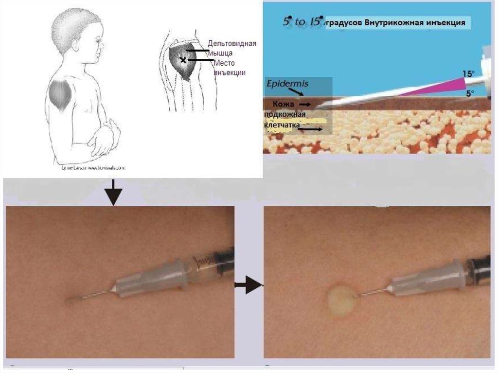 Места постановки внутрикожной инъекции. Внутрикожное Введение БЦЖ. Техника постановки вакцины БЦЖ. Место инъекции БЦЖ техника постановки. Внутрикожная инъекция проба манту.