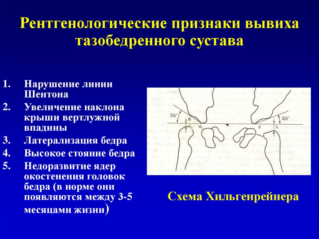 Схема врожденного вывиха бедра