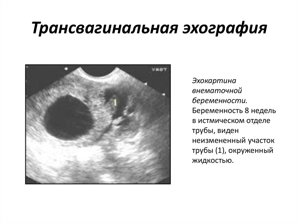 Трансвагинальное узи на ранних сроках беременности. Внематочная беременность в истмическом отделе УЗИ. Внематочная Трубная беременность УЗИ. Клиника Трубная внематочная беременность. Трубная беременность УЗИ 5 недель беременности.