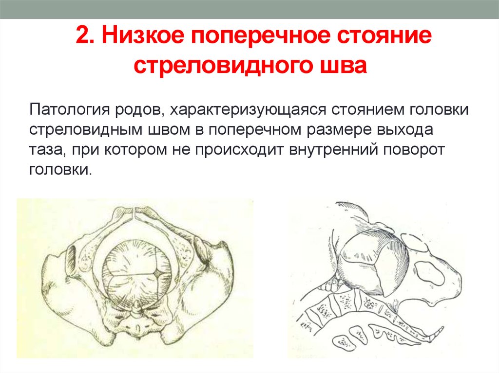 Низкое положение. Низкое поперечное стояние стреловидного. Низкое поперечное стояние стреловидного шва. Высокое поперечное стояние стреловидного шва. Высокое прямое и низкое поперечное стояние стреловидного шва.