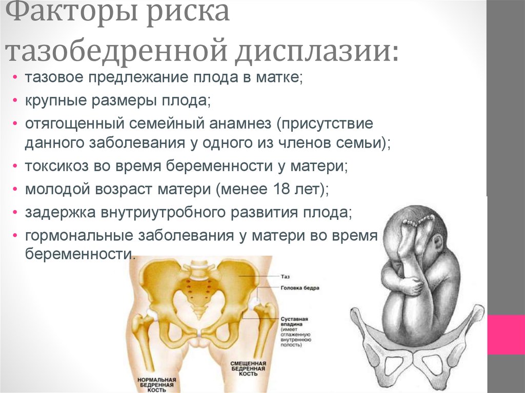 Дисплазия тазобедренных суставов у новорожденных. Факторы риска дисплазии тазобедренных суставов. Этиология дисплазии тазобедренного сустава. Врожденный вывих бедра этиология. Врожденный вывих бедра эпидемиология.