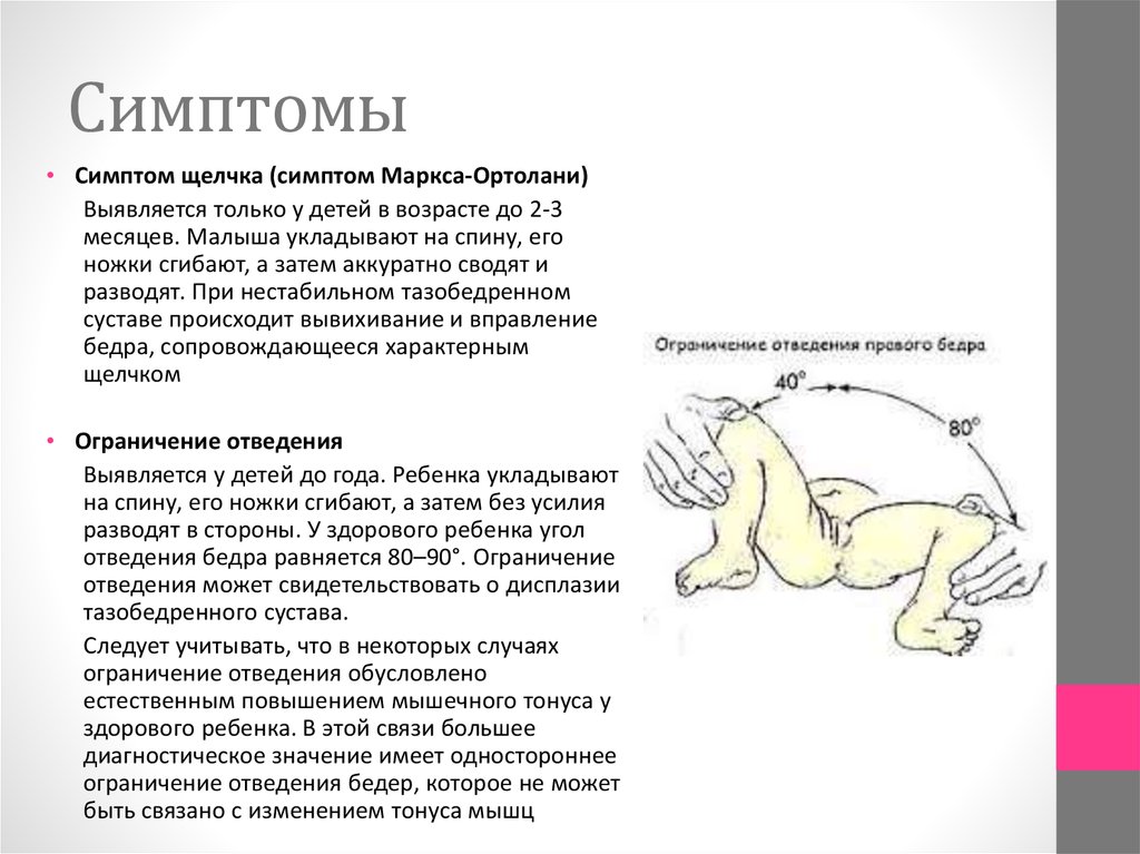 Дисплазия тазобедренного сустава причины. Симптом Маркса Ортолани при дисплазии тазобедренного. Дисплазия тазобедренных суставов у детей 5 месяцев симптомы. У ребёнка щелкает тазобедренный сустав в 1 год. Симптом щелчка при врожденном вывихе бедра.