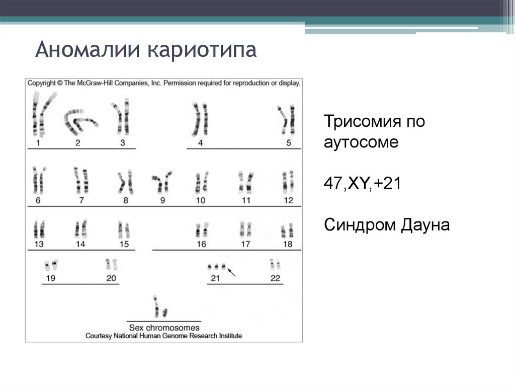 Аномалии хромосом. Кариотип хромосомные аномалии. Аномалии кариотипа человека. Патология хромосом хромосомные болезни кариотип. Аномальный кариотип человека болезни.