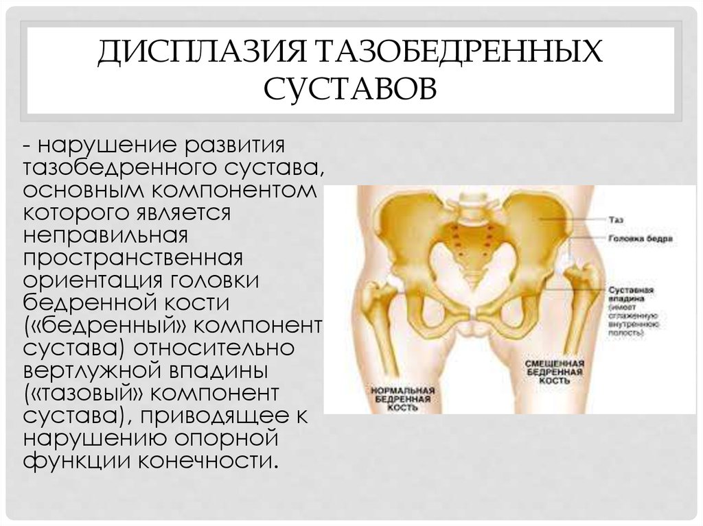 Дисплазия симптомы. Дисплазия головок бедренных костей. Диспластический Тип развития тазобедренных суставов. Дисплазия тазобедренных суставов. Дисплазия тазобежренногосустава.