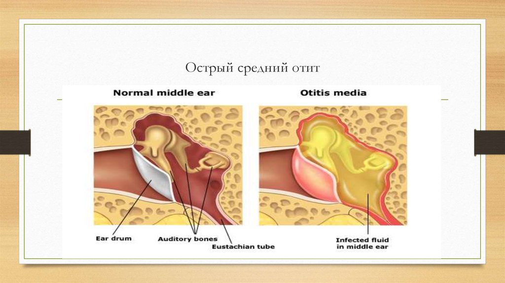 Острый средний. Острый экссудативный Гнойный отит. Острый Катар среднего уха клиника.