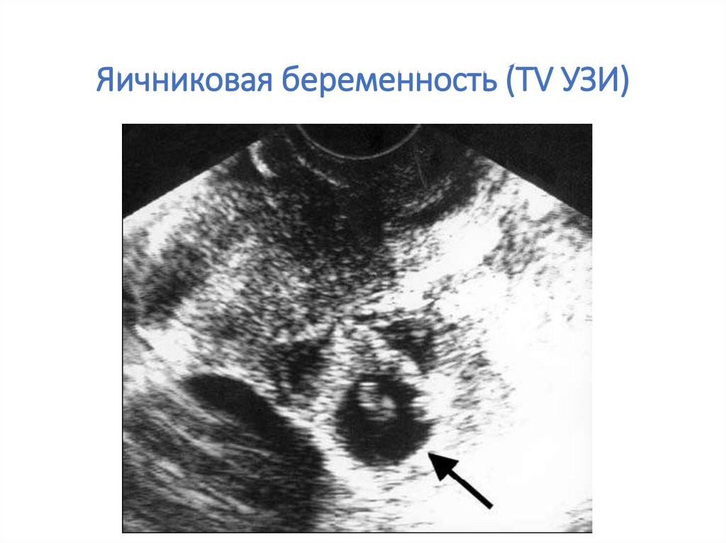 Боль в яичниках на ранних сроках беременности. Внематочная яичниковая беременность на УЗИ. Внематочная Трубная беременность УЗИ. Внематочная беременность в яичнике на УЗИ. Внематочная беременность УЗИ картина.