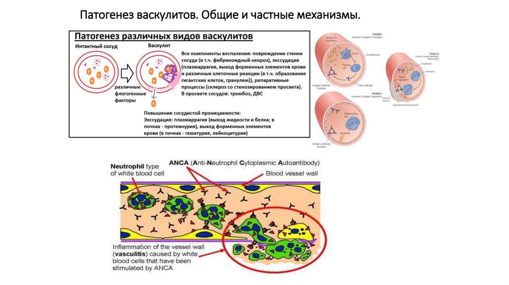 Анца ассоциированные васкулиты презентация