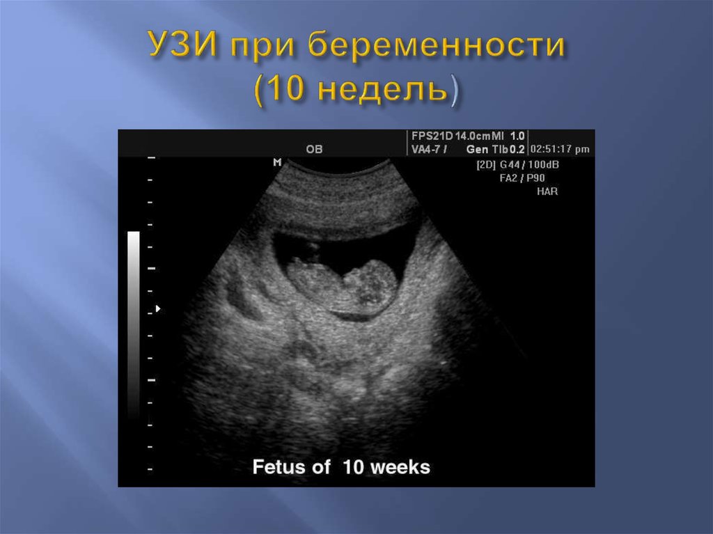 Узи при беременности на 10 неделе фото