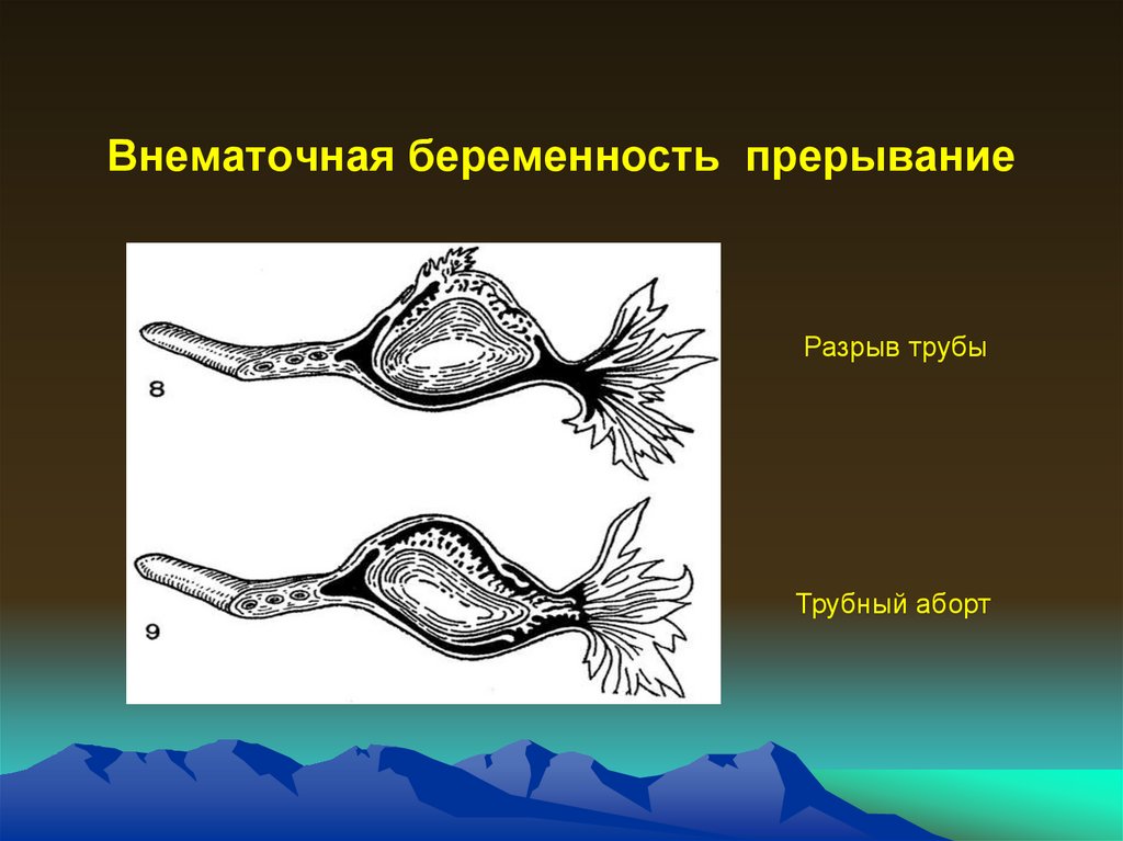 Эктопическая беременность презентация