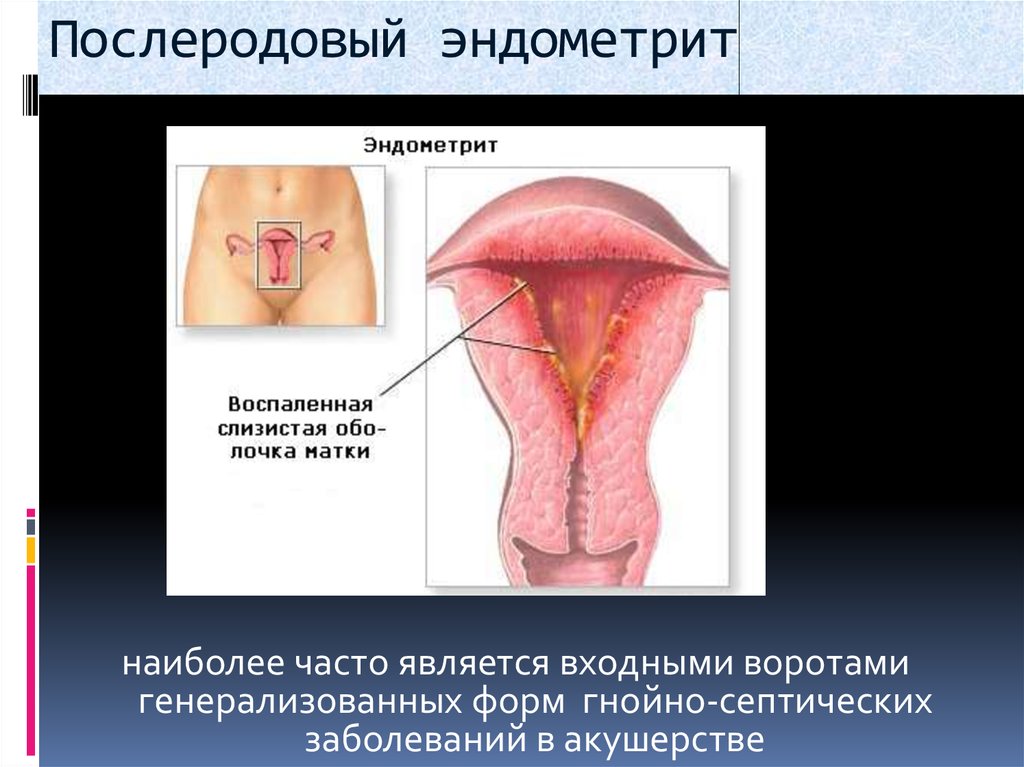 Послеродовой эндометрит фото