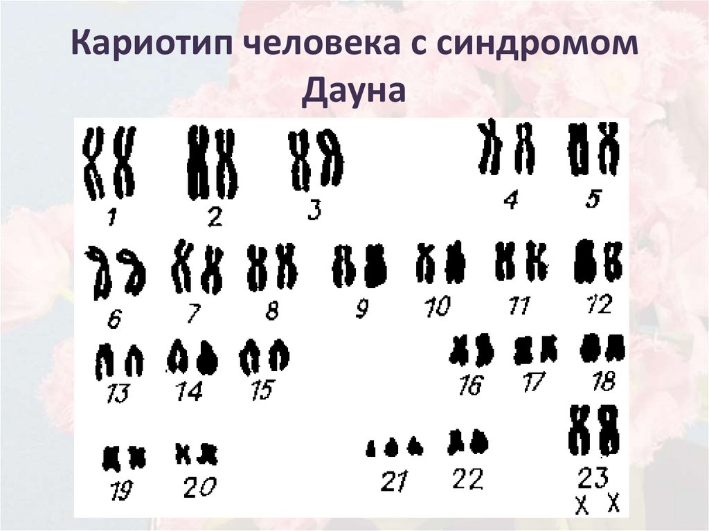 Набор дауна. Кариограмма человека с синдромом Дауна. Хромосомная карта кариотип. Кариограмма хромосом синдром Дауна. Формула кариотипа при синдроме Дауна.
