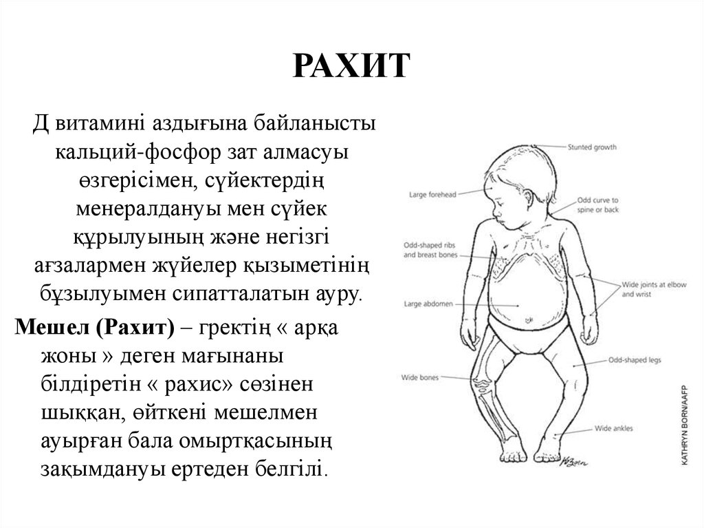 Признаки рахита