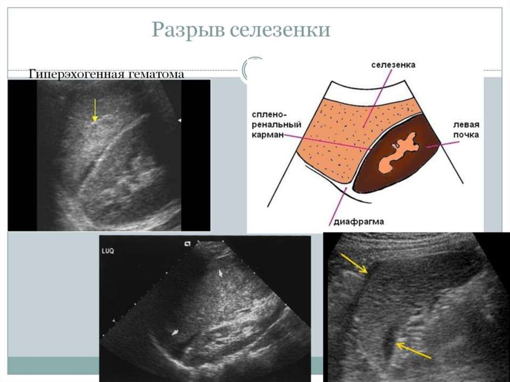 Разрыв печени на узи фото