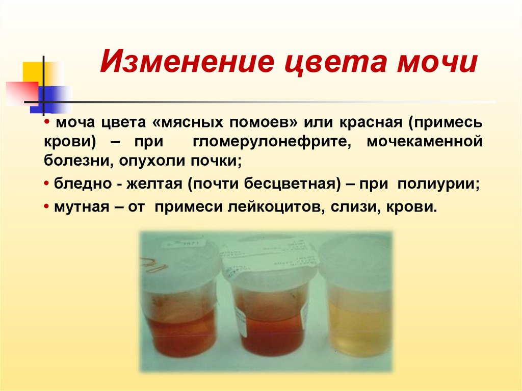 Моча часто. Моча цвета мясных помоев. Цвет мясных помоев цвет мясных помоев. Изменение цвета мочи. Цвет мчных помоев иочи.