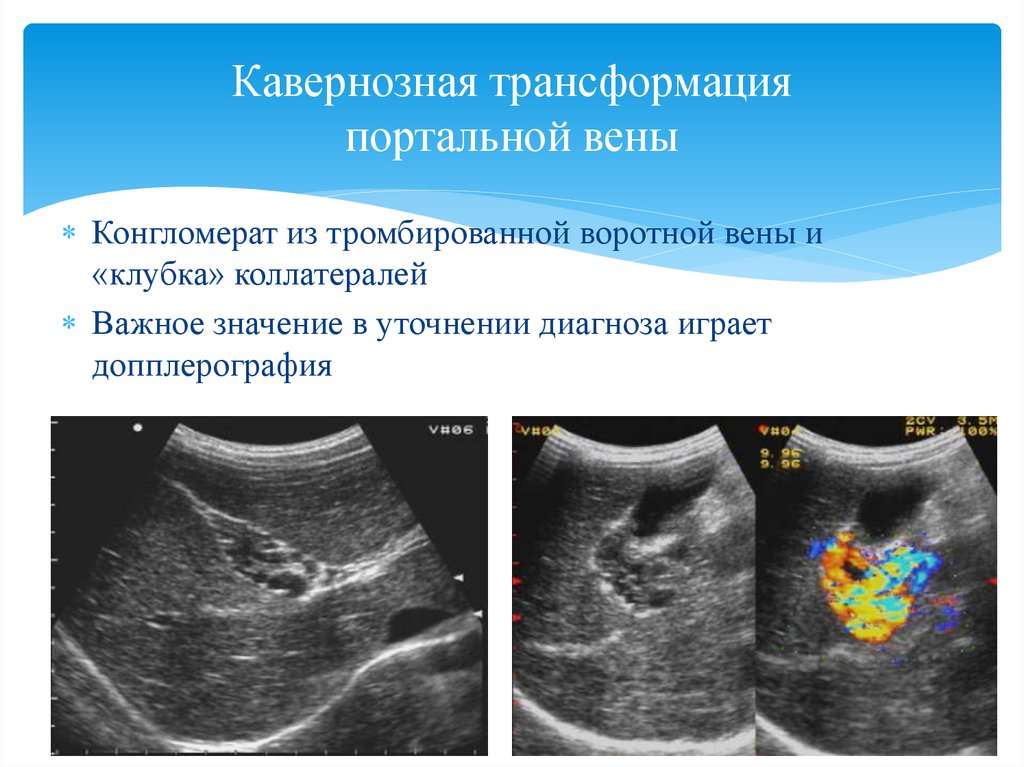 Тромбоз воротной. Норма воротной вены на УЗИ. Дилатация воротной вены на УЗИ. Портальная Вена на УЗИ норма. Воротная Вена печени на УЗИ.