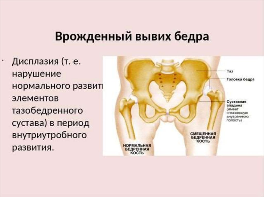 Вывих тазобедренного сустава у взрослых симптомы. Врожденный вывих тазобедренного сустава презентация. Дисплазия подвывих тазобедренного сустава. Врожденный подвывих тазобедренного сустава. Врожденный вывих тазобедренного сустава.