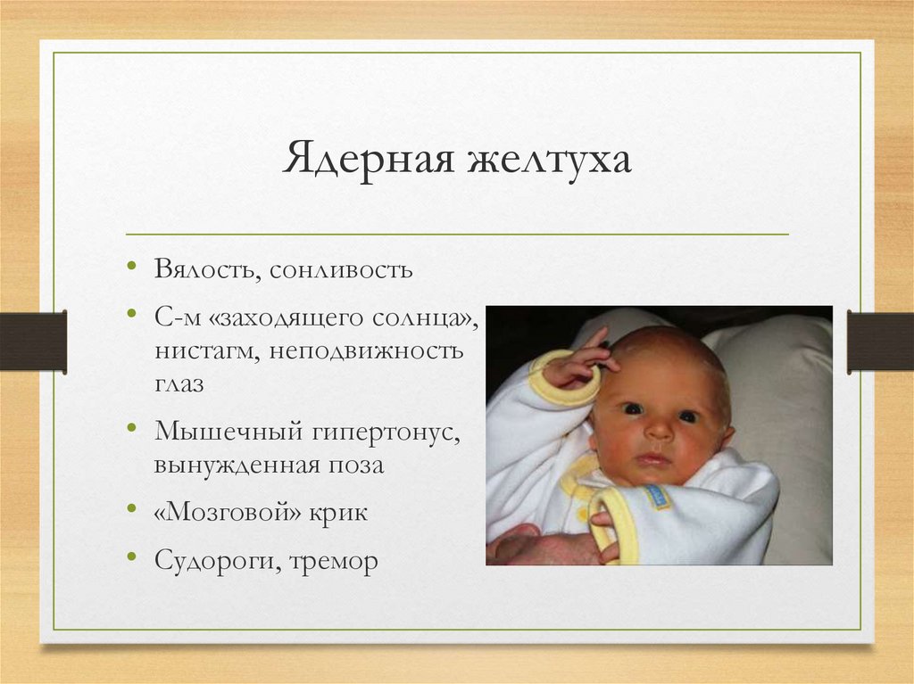 Сколько держится желтуха у новорожденных. Ядерная желтуха новорожденных. Ядерная желтуха новорожденных симптомы. Что такое ядерная желтуха у новорожденного. Ядерная желтуха новоржд.