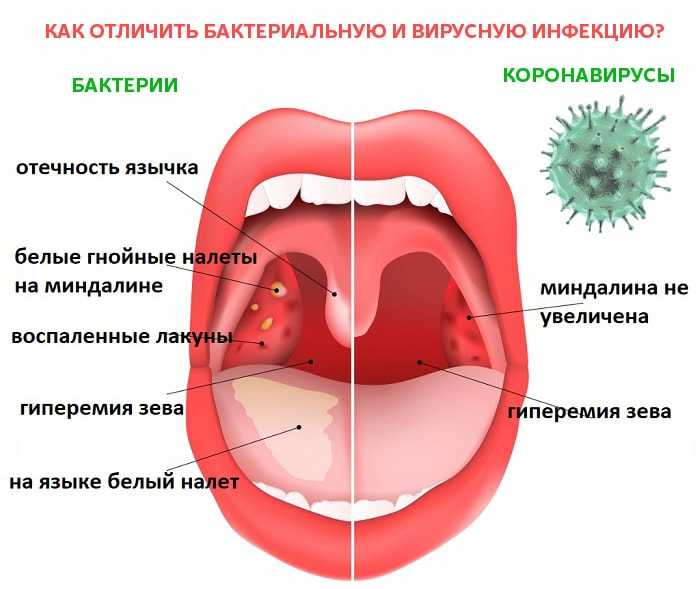 Острый фарингит у детей фото