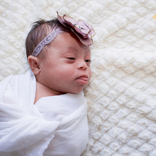 Как выглядит новорожденный ребенок с синдромом дауна фото