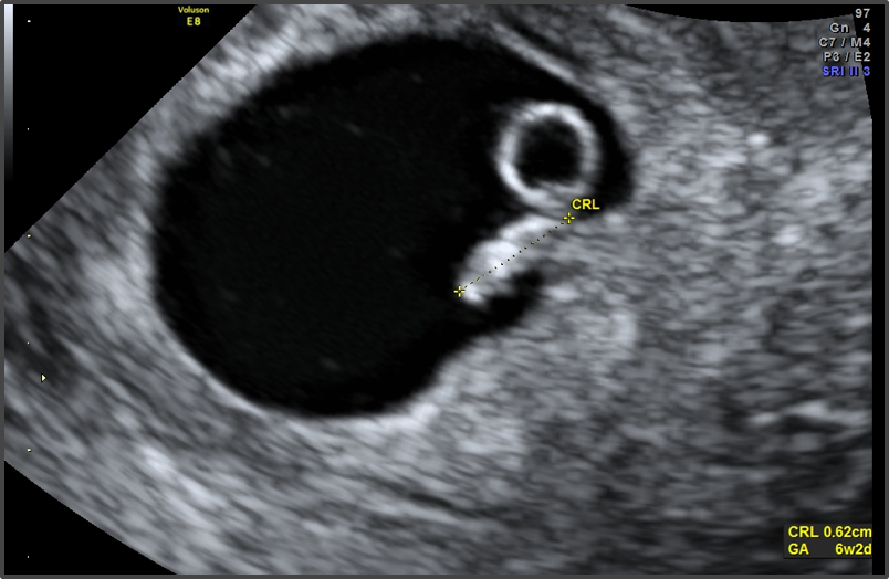 Ребенок 6 недель беременности фото