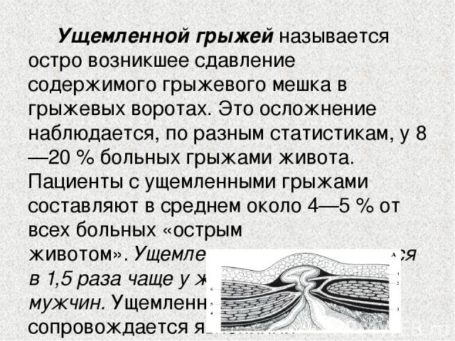 Пупочная грыжа код по мкб 10