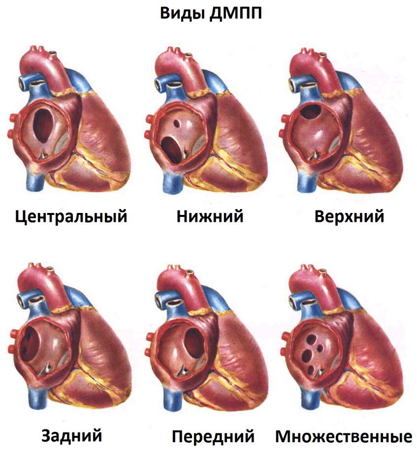 Как выглядит порок сердца на картинке