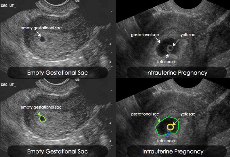 Тест при внематочной беременности на ранних сроках фото