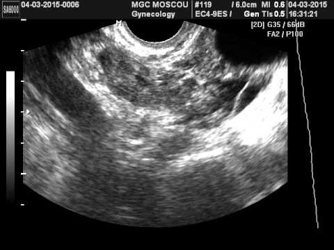 На узи видно внематочную. Внематочная беременность 6 недель УЗИ. УЗИ внематочной беременности 5 недель. УЗИ интерстициальной внематочной беременности.